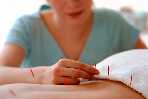 Acupuntora poniendo agujas al paciente