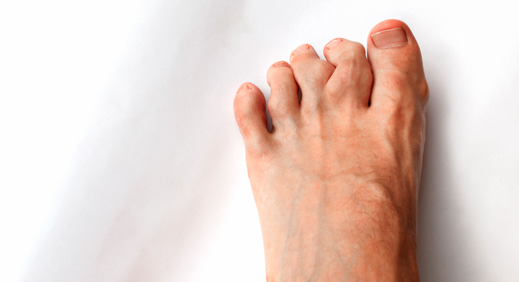 Pies con artritis reumatoide