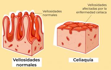 Causas de la celiaquía Causas de la celiaquía (ilustración)