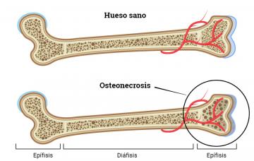Causas y factores de riesgo de la osteonecrosis Causa de osteonecrosis