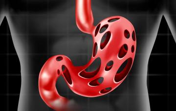 Epitelio del esófago Complicaciones del reflujo gastroesofágico