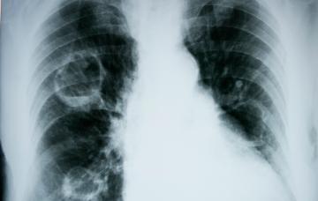 Radiografía de un edema pulmonar Diagnóstico del edema pulmonar