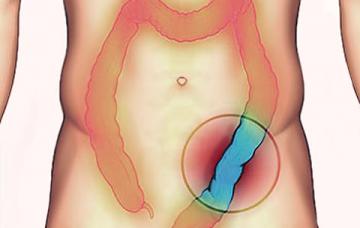 Causas de la colitis ulcerosa Causas de la colitis ulcerosa