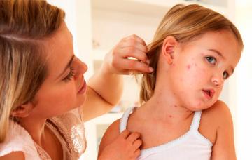 Síntomas y diagnóstico de la varicela