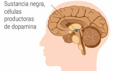Tipos de párkinson Ilustración de un tipo de párkinson