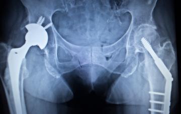 Tratamiento de la osteonecrosis Cómo tratar la osteonecrosis