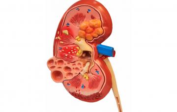 Riñón con tumor de Wilms Tumor de Wilms en un riñón