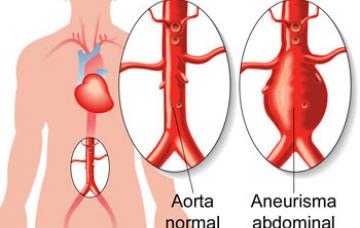 Causas de aneurisma Causas de aneurisma