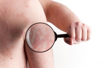 Causas de la psoriasis Causas de la aparición de psoriasis en la piel