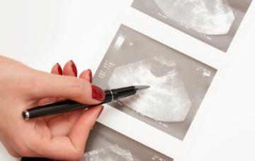 Prueba diagnóstica de imagen del cáncer de riñón Diagnóstico del cáncer de riñón