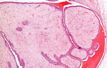 Tumores benignos de la mama Imagen al detalle de un tumor benigno de la mama
