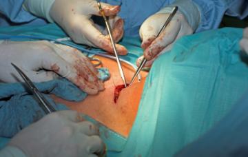 Tratamiento del cáncer de tiroides Incisión para eliminar el tumor en la tiroides