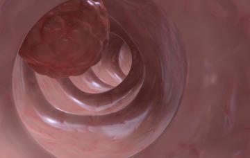Pronóstico del cáncer de colon Localización del cáncer de colon