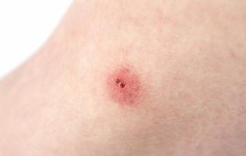 Síntomas de una picadura de insecto Síntomas de una picadura de insecto en el cuerpo