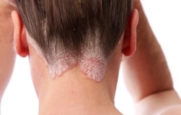 Síntomas de la psoriasis Mujer con síntomas de psoriasis en la nuca