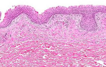 Patogenia de la cistitis Patogenia y clasificación de la cistitis