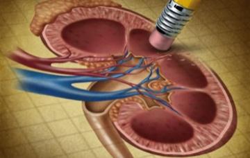 Nefrectomía parcial Tratamiento del cáncer de riñón