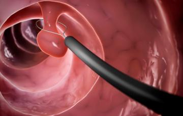 Tratamiento de los pólipos uterinos Extirpación de un pólipo uterino