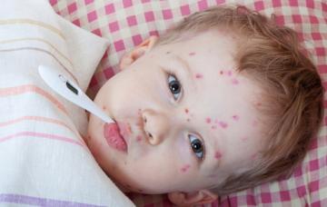 Tratamiento de la varicela