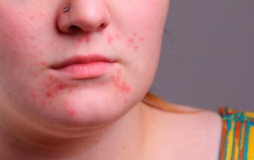 La varicela en situaciones especiale La varicela en situaciones especiales