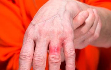 Alergia al níquel Signos de alergia al níquel