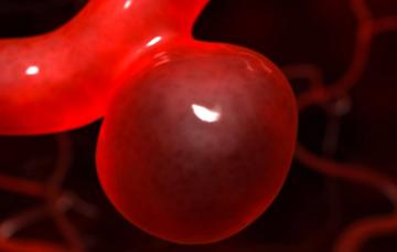 Dilatación de un vaso sanguíneo Aneurisma