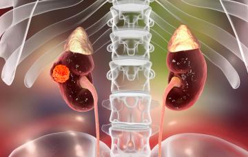 Cáncer de riñón Ubicación del cáncer de riñón