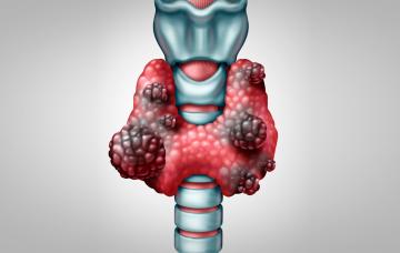 Cáncer de tiroides: síntomas Cáncer de tiroides