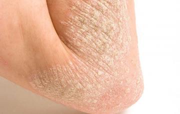 Psoriasis Codo afectado por psoriasis