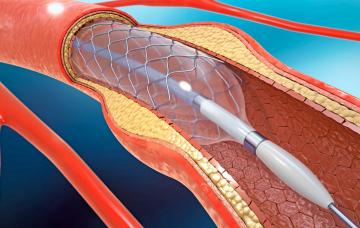 Stent coronario, en qué consiste y cuándo está indicado Stent coronario