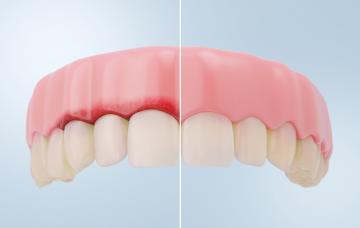 Encías sanas vs gingivitis Comparación de encías sanas vs gingivitis en la representación 3D detallada.