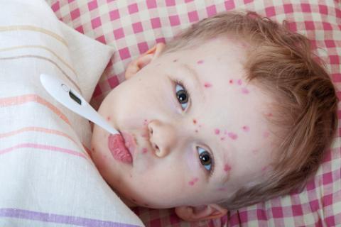 Resultat d'imatges de la varicela