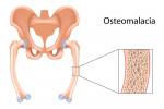 Causas de la osteomalacia