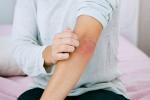 Síntomas de urticaria en el brazo