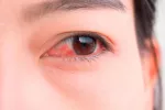 Alergia ocular Alergias en ojos y oídos