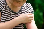 Alergias cutáneas Niña pequeña con alergias cutáneas