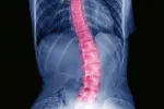 Columna vertebral con escoliosis Escoliosis