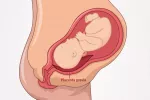 Placenta previa Placenta previa