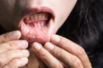 Síntomas del cáncer de la cavidad oral