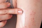 Eczema en un brazo por alergia al níquel