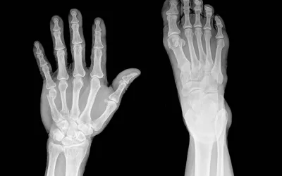 Fractura de dedo Radiografías de fractura de dedo