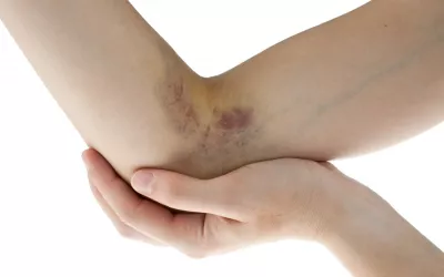 Contusión Codo con una contusión