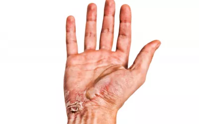 Qué son las quemaduras Quemaduras en la mano