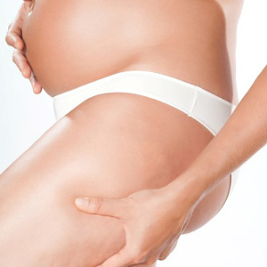 Mito celulitis embarazo