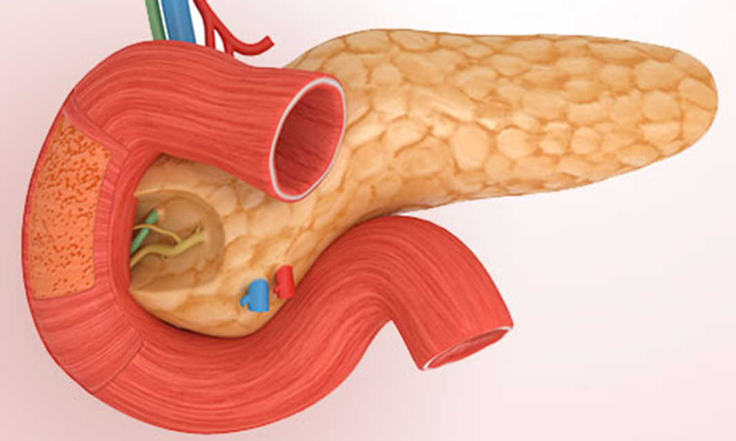 Diagnóstico de los tumores exocrinos de páncreas
