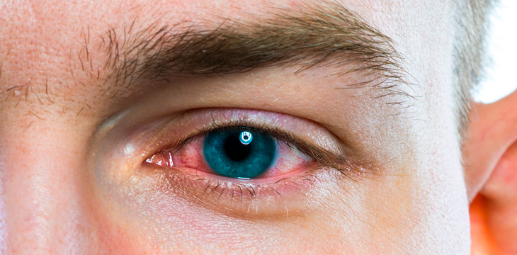 Síntomas de alerta: conjuntivitis