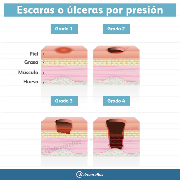 Escaras, infografía