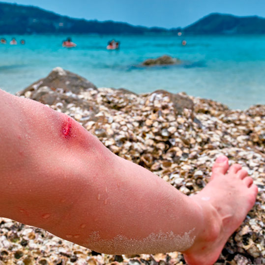 Staphylococcus aureus resistente a la meticilina (SAEM):