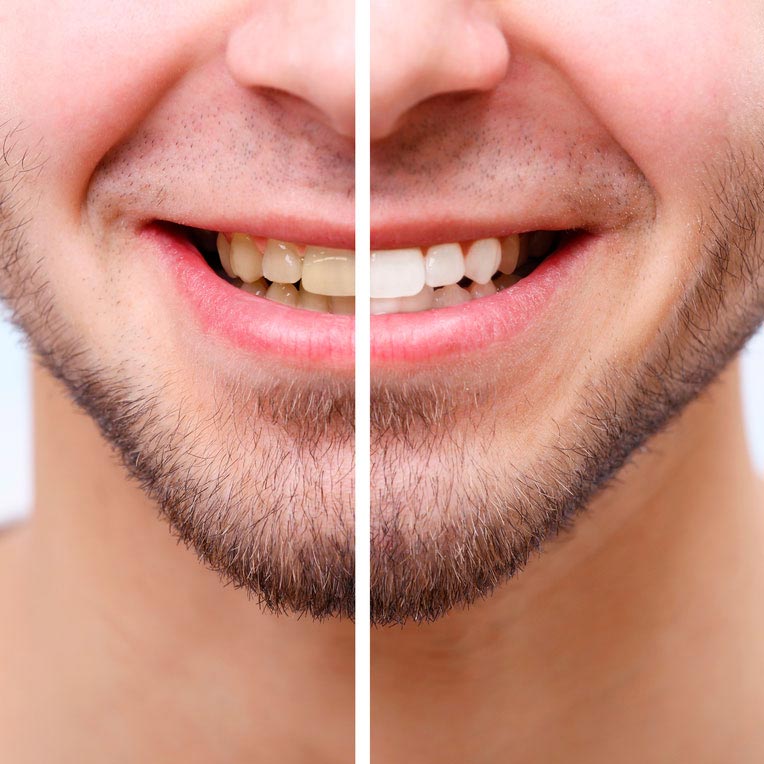 Blanqueamiento dental