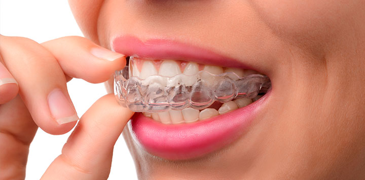 Ortodoncia más estética